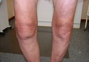 How to heal knee arthrosis