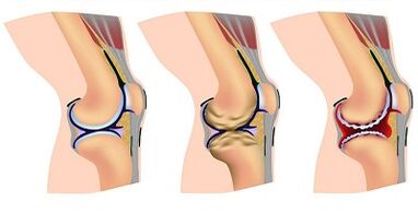Stages of development of knee joint arthrosis